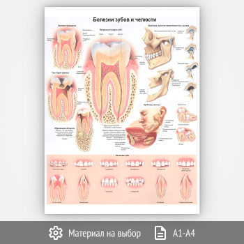 Плакат «Болезни зубов и челюсти» (ЗОЖ-32, 1 лист)